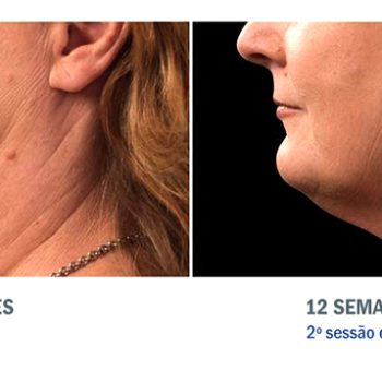 Papada tratada com CoolSculpting