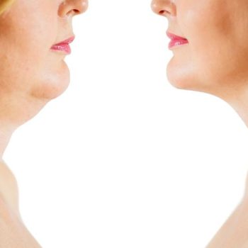 Tratando a papada melhoramos o contorno facial